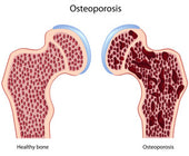 Top Reasons People Fall in Their Home: Osteoporosis
